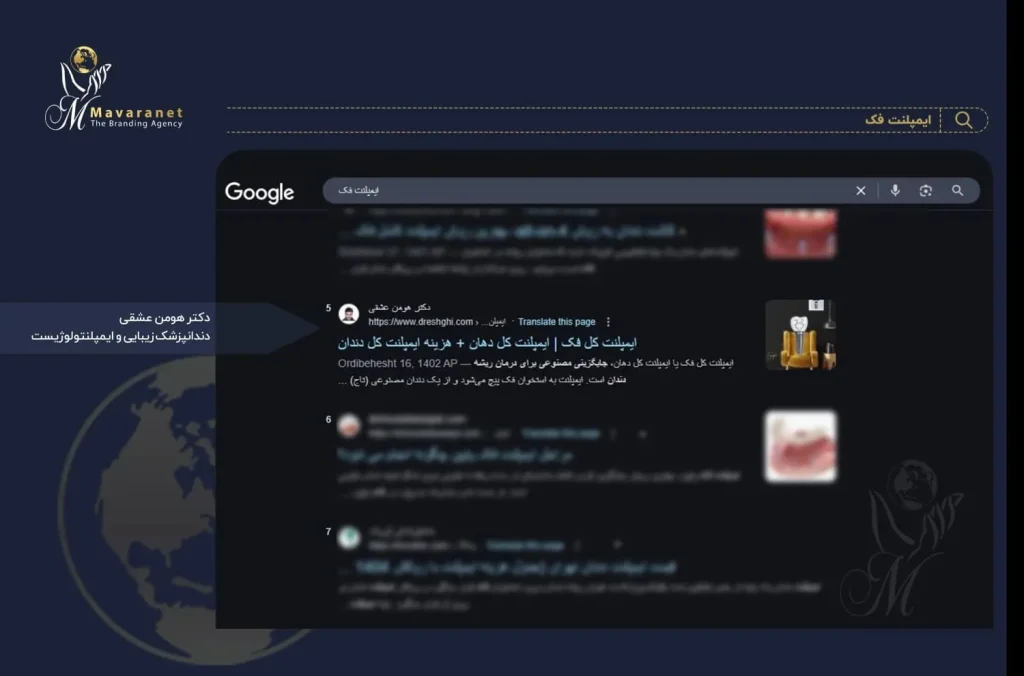 سئو کلمه ایمپلنت فک