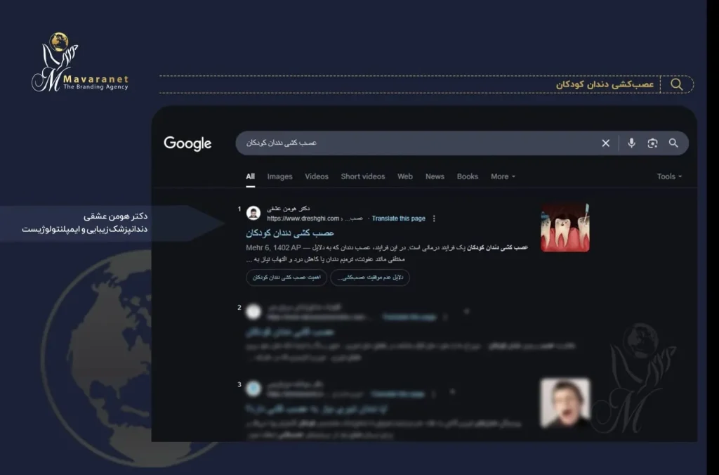 سئو کلمه عصب کشی دندان کودکان