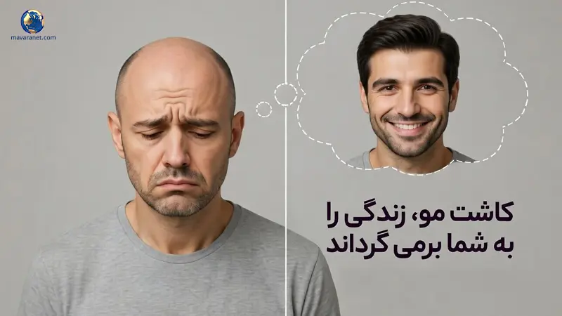 تبلیغات کاشت مو